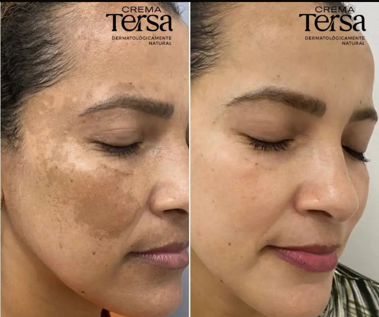 Crema Tersa Rejuvenecedora, Despicmentante, Quita paño, Acne, Imperfecciones