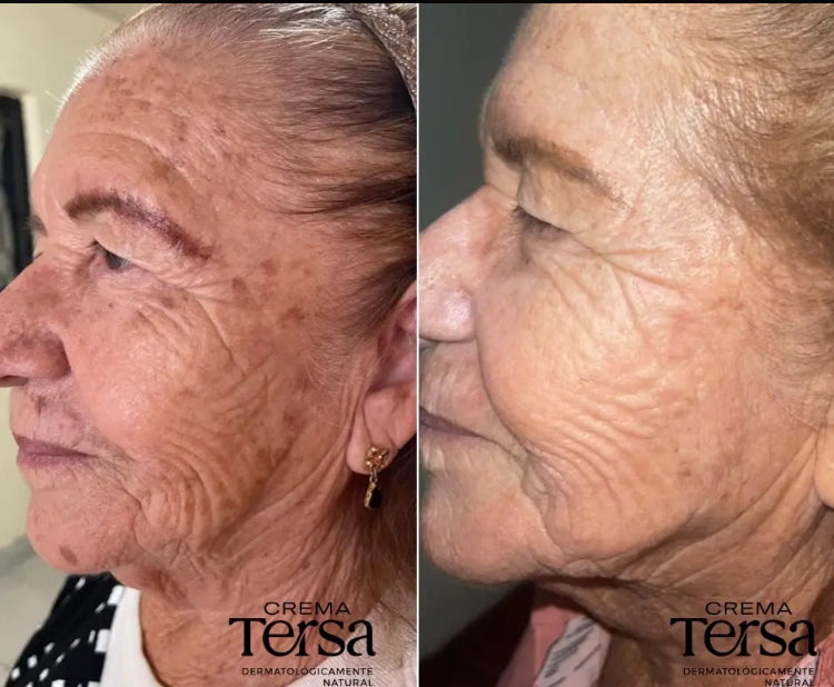 Crema Tersa Rejuvenecedora, Despicmentante, Quita paño, Acne, Imperfecciones