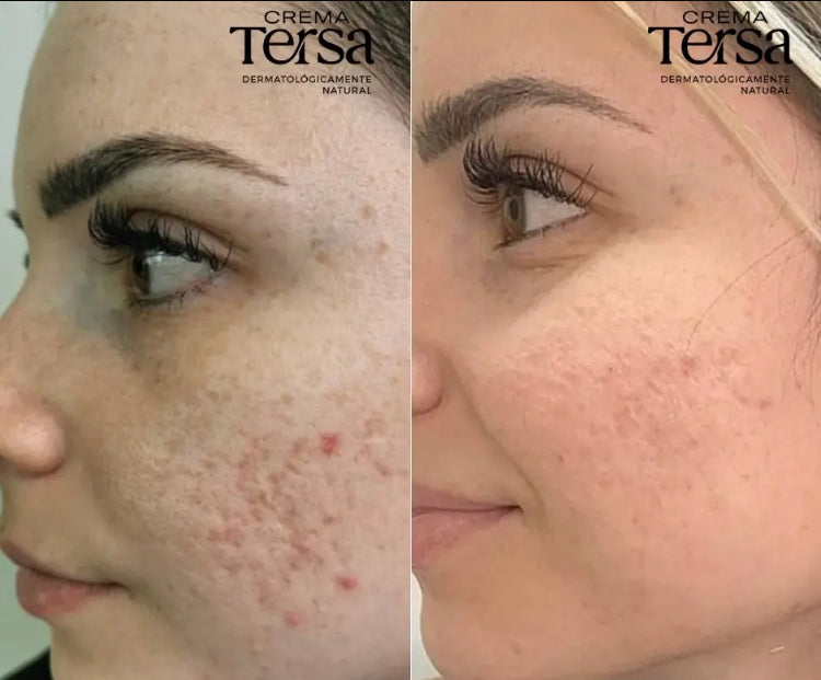 Crema Tersa Rejuvenecedora, Despicmentante, Quita paño, Acne, Imperfecciones