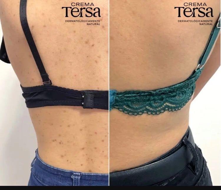 Crema Tersa Rejuvenecedora, Despicmentante, Quita paño, Acne, Imperfecciones