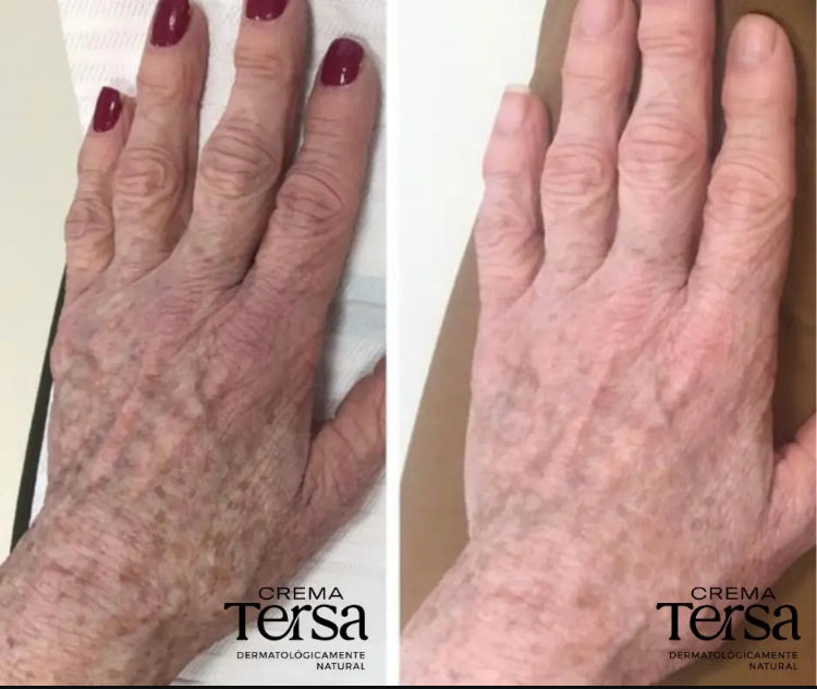 Crema Tersa Rejuvenecedora, Despicmentante, Quita paño, Acne, Imperfecciones