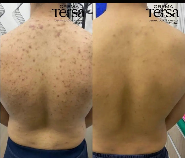 Crema Tersa Rejuvenecedora, Despicmentante, Quita paño, Acne, Imperfecciones